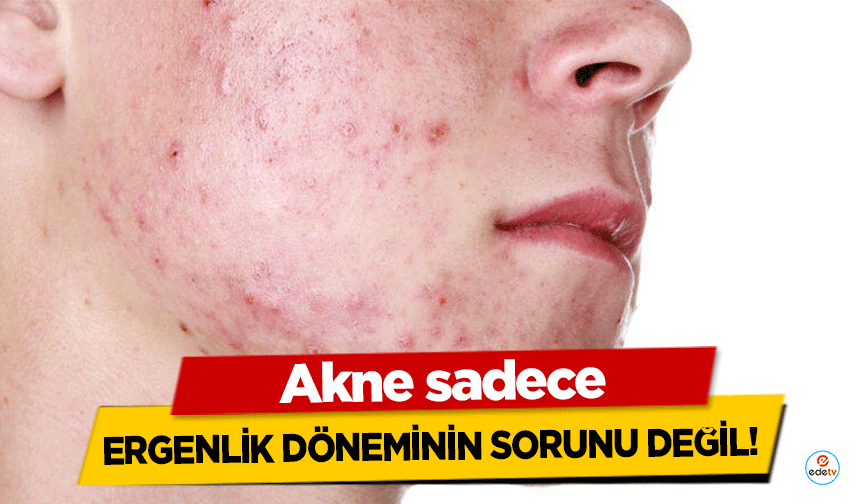 Akne sadece ergenlik döneminin sorunu değil!