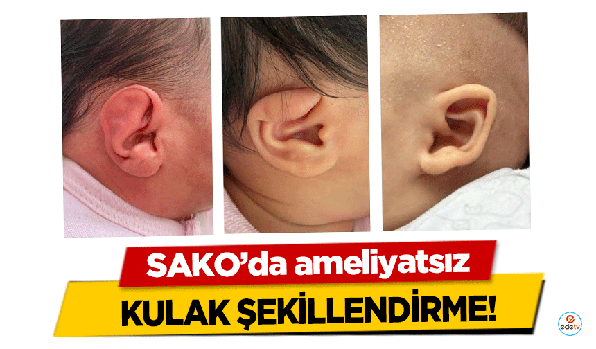 SAKO’da ameliyatsız kulak şekillendirme!