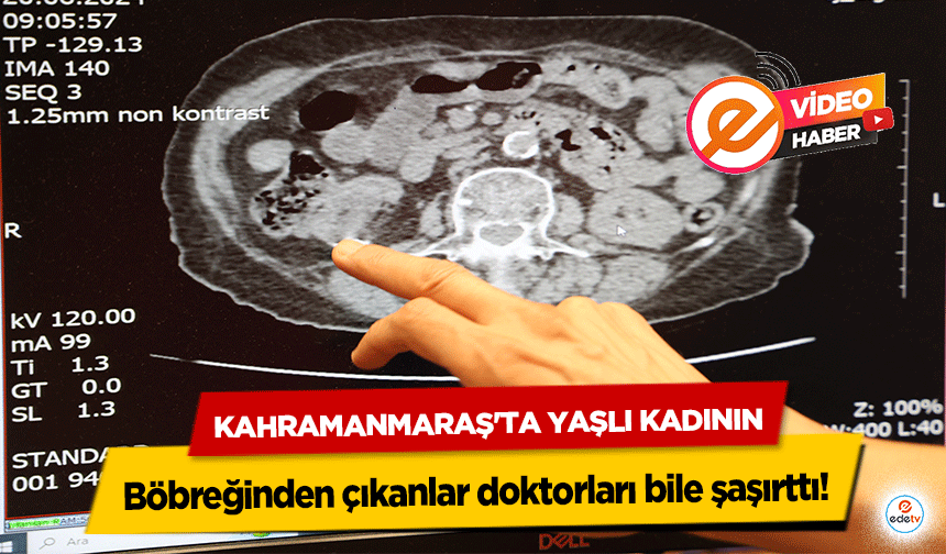 Kahramanmaraş'ta Yaşlı Kadının böbreğinden çıkanlar doktorları bile şaşırttı!